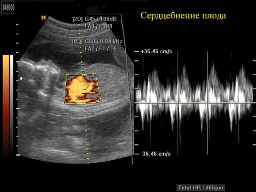 Сердцебиение плода