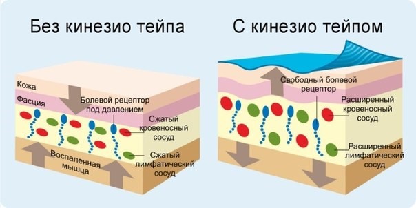 Принцип работы кинезио-тейпа